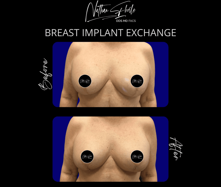 Breast Implant Exchange case 11 before and after results at Weston Center for Plastic Surgery