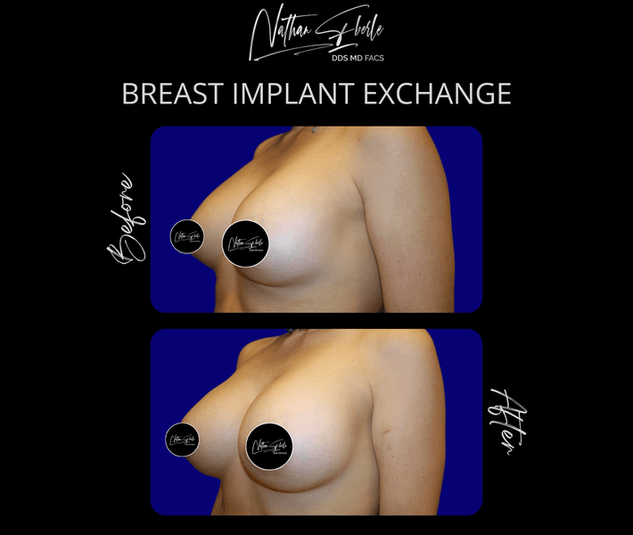 Breast Implant Exchange case 12 before and after results at Weston Center for Plastic Surgery
