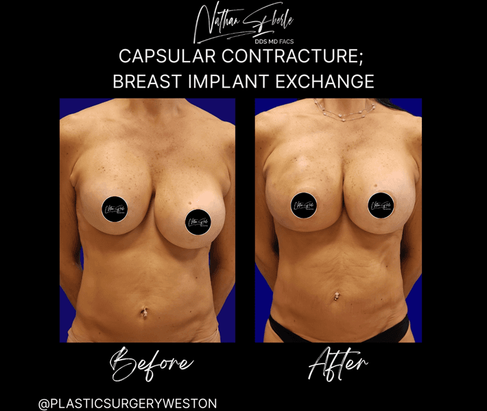 Breast Implant Exchange case 13 before and after results at Weston Center for Plastic Surgery
