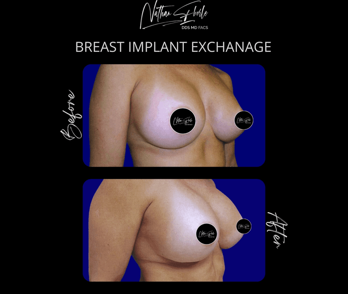 Breast Implant Exchange case 14 before and after results at Weston Center for Plastic Surgery
