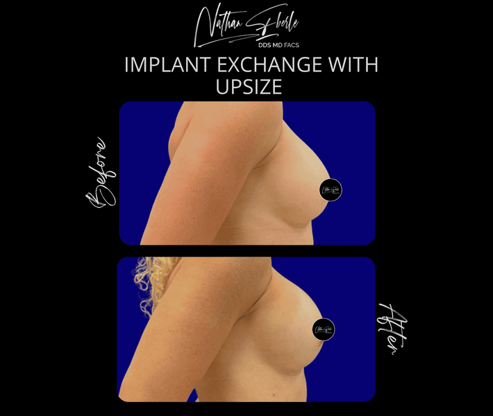Breast Implant Exchange case 15 before and after results at Weston Center for Plastic Surgery