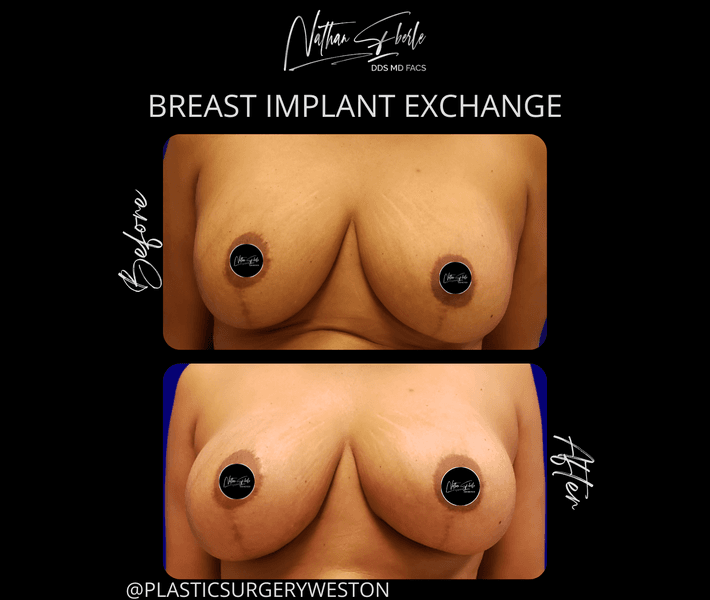 Breast Implant Exchange case 16 before and after results at Weston Center for Plastic Surgery