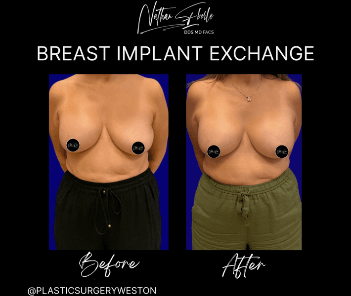 Breast Implant Exchange case 17 before and after results at Weston Center for Plastic Surgery