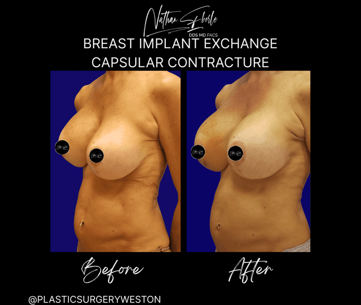Breast Implant Exchange case 18 before and after results at Weston Center for Plastic Surgery