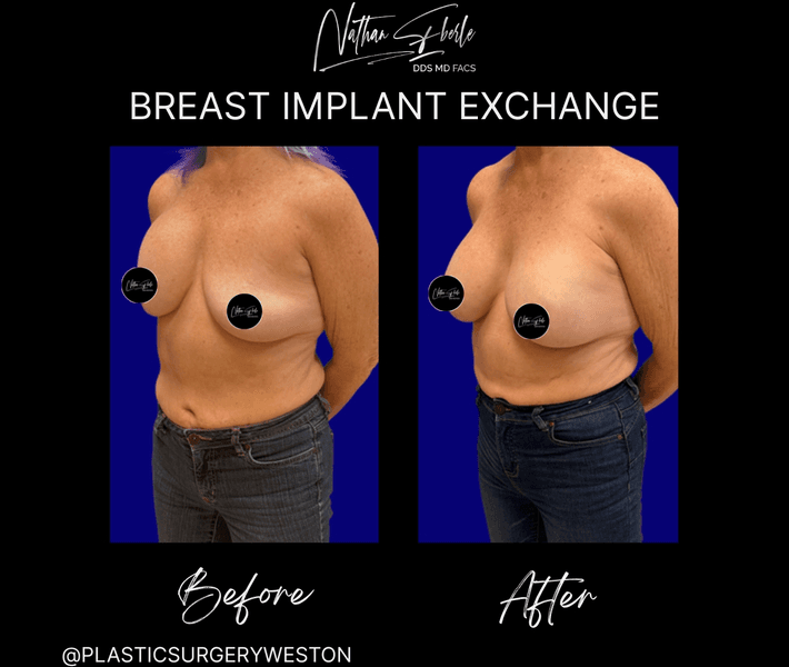 Breast Implant Exchange case 19 before and after results at Weston Center for Plastic Surgery