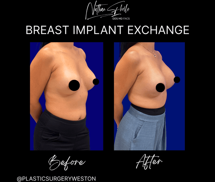 Breast Implant Exchange case 2 before and after results at Weston Center for Plastic Surgery