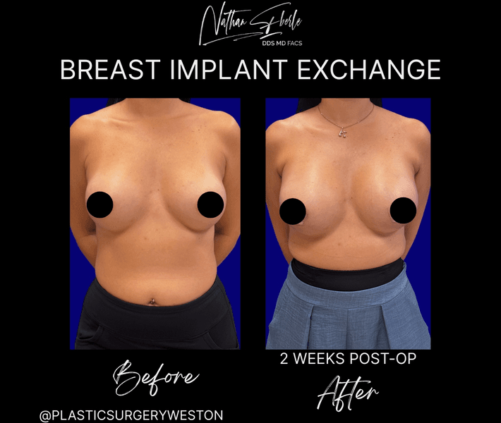 Breast Implant Exchange case 20 before and after results at Weston Center for Plastic Surgery