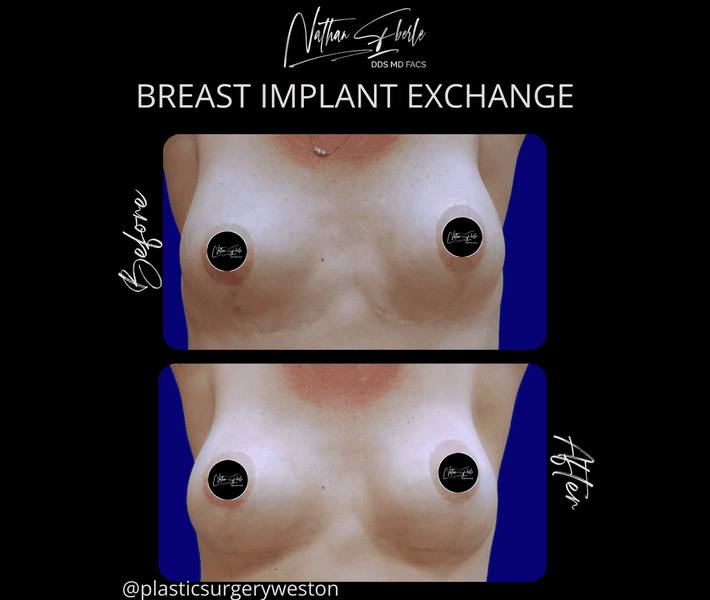 Breast Implant Exchange case 21 before and after results at Weston Center for Plastic Surgery