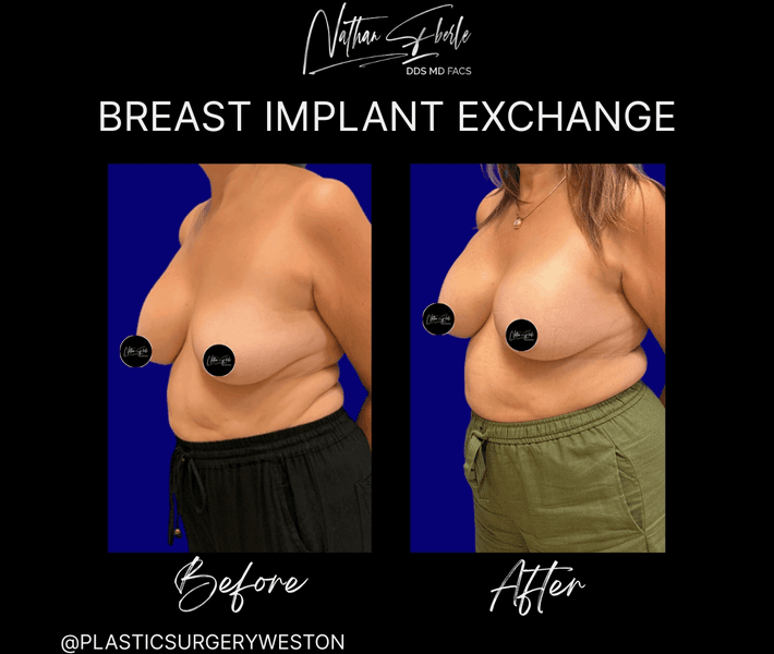 Breast Implant Exchange case 22 before and after results at Weston Center for Plastic Surgery