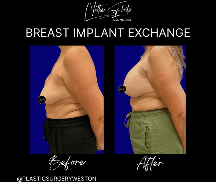 Breast Implant Exchange case 23 before and after results at Weston Center for Plastic Surgery