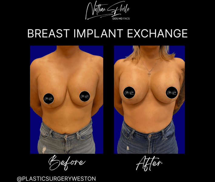 Breast Implant Exchange case 24 before and after results at Weston Center for Plastic Surgery