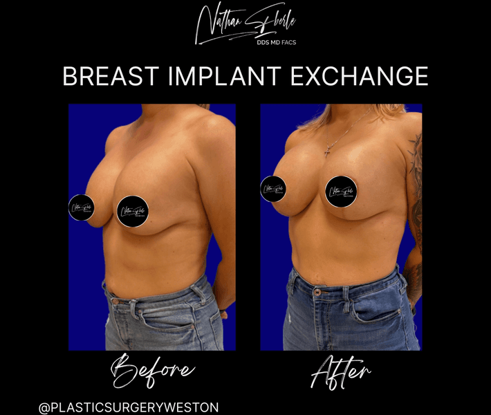 Breast Implant Exchange case 25 before and after results at Weston Center for Plastic Surgery