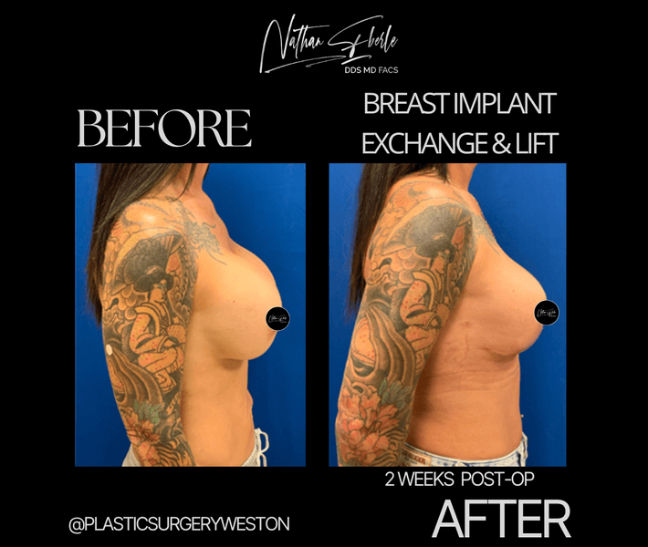 Breast Implant Exchange case 26 before and after results at Weston Center for Plastic Surgery