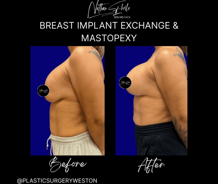 Breast Implant Exchange case 27 before and after results at Weston Center for Plastic Surgery