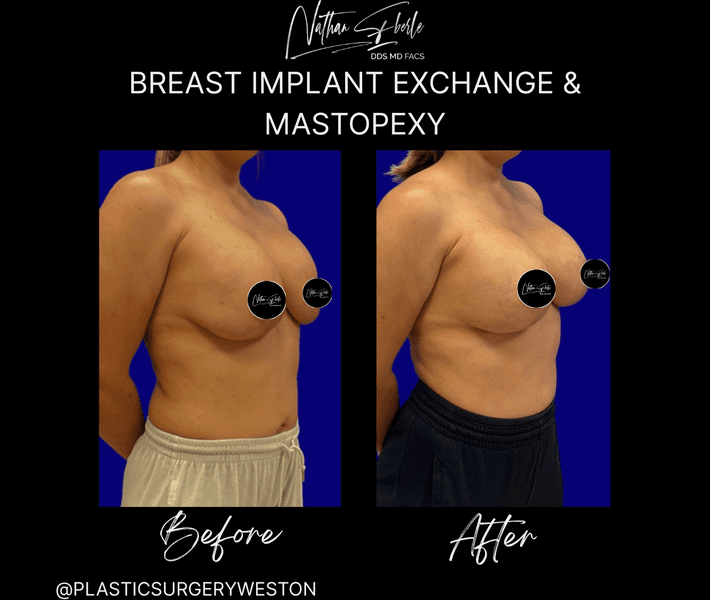 Breast Implant Exchange case 28 before and after results at Weston Center for Plastic Surgery