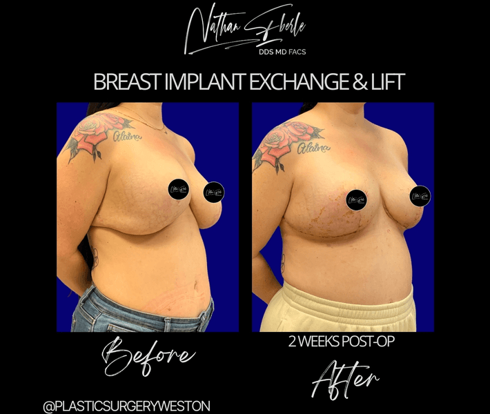 Breast Implant Exchange case 29 before and after results at Weston Center for Plastic Surgery