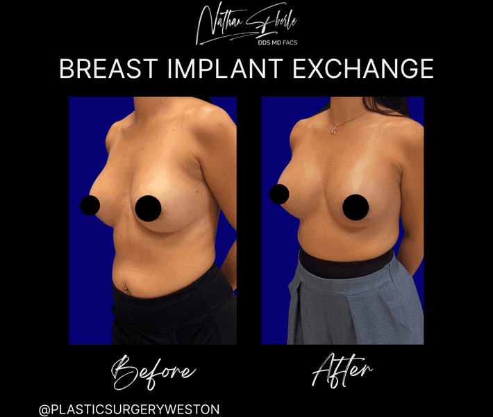 Breast Implant Exchange case 3 before and after results at Weston Center for Plastic Surgery