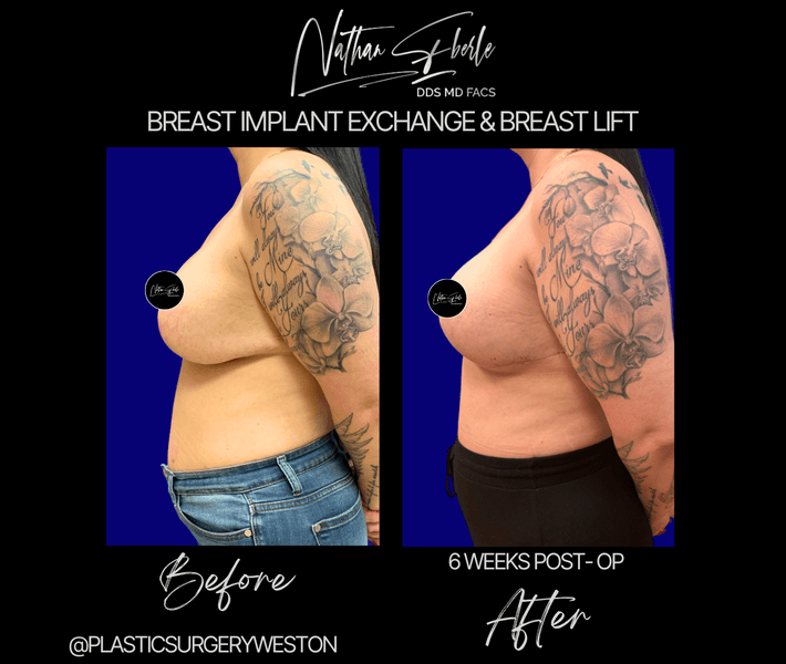 Breast Implant Exchange case 30 before and after results at Weston Center for Plastic Surgery