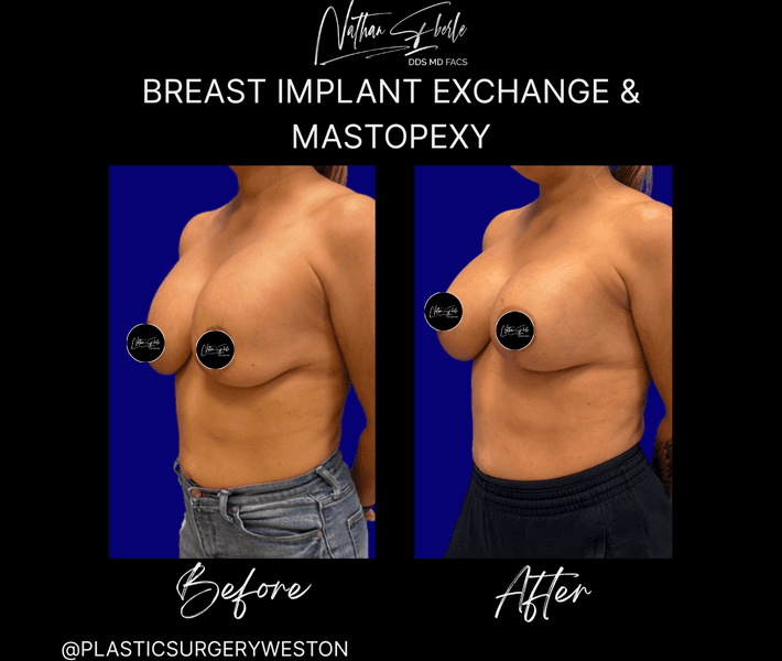 Breast Implant Exchange case 31 before and after results at Weston Center for Plastic Surgery