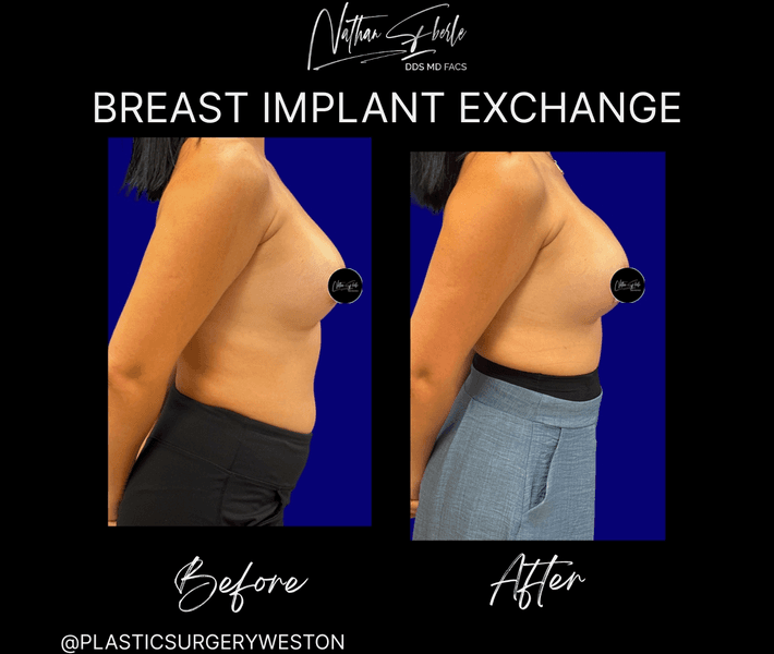 Breast Implant Exchange case 4 before and after results at Weston Center for Plastic Surgery