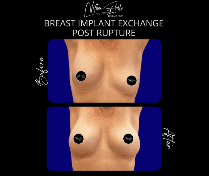 Breast Implant Exchange case 5 before and after results at Weston Center for Plastic Surgery