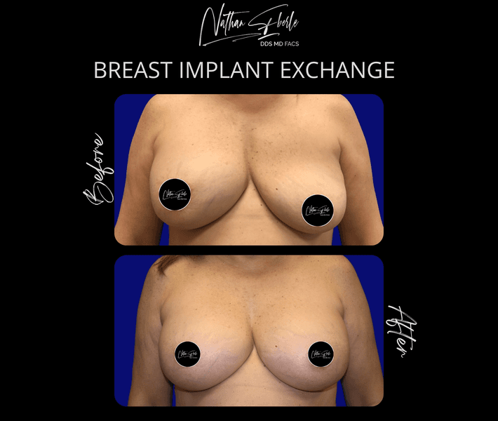 Breast Implant Exchange case 7 before and after results at Weston Center for Plastic Surgery