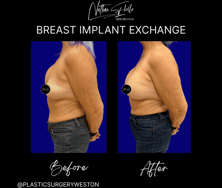 Breast Implant Exchange case 8 before and after results at Weston Center for Plastic Surgery