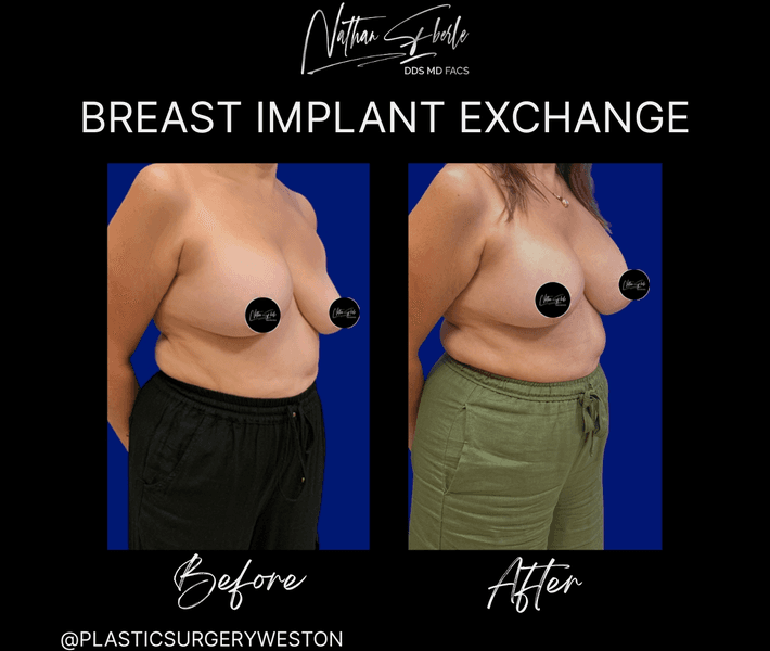 Breast Implant Exchange case 9 before and after results at Weston Center for Plastic Surgery