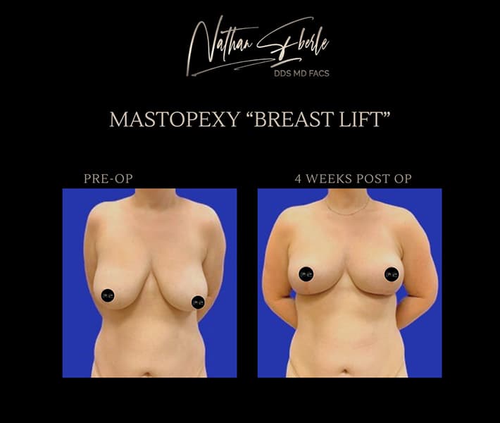 Breast Lift before and after case 15, actual patient at Weston Center for Plastic Surgery
