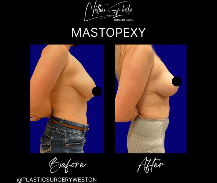 Breast Lift case 16 before and after results at Weston Center for Plastic Surgery