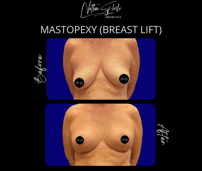 Breast Lift case 17 before and after results at Weston Center for Plastic Surgery