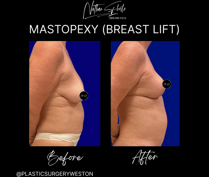 Breast Lift case 18 before and after results at Weston Center for Plastic Surgery