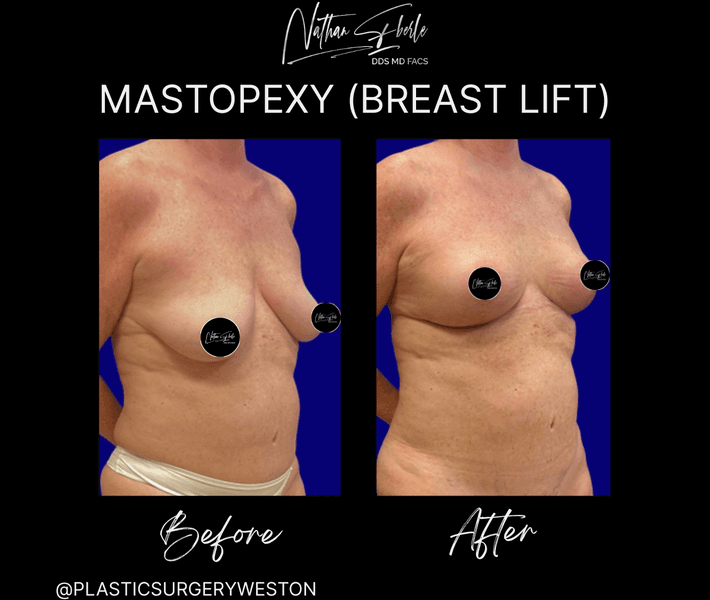 Breast Lift case 19 before and after results at Weston Center for Plastic Surgery