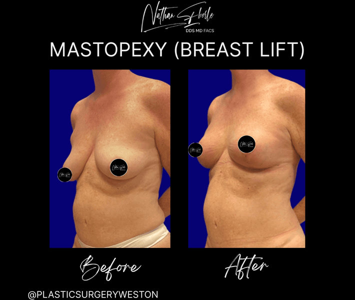 Breast Lift case 20 before and after results at Weston Center for Plastic Surgery