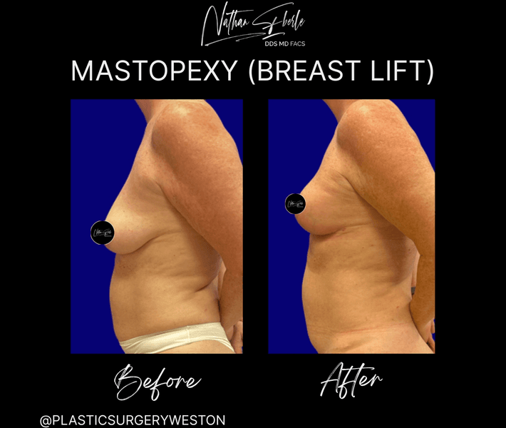 Breast Lift case 21 before and after results at Weston Center for Plastic Surgery