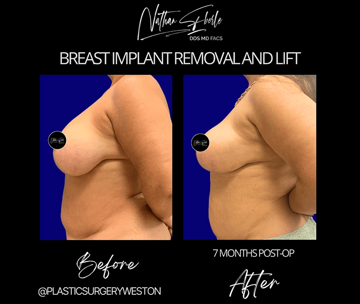 Breast Lift before and after case 4, actual patient at Weston Center for Plastic Surgery