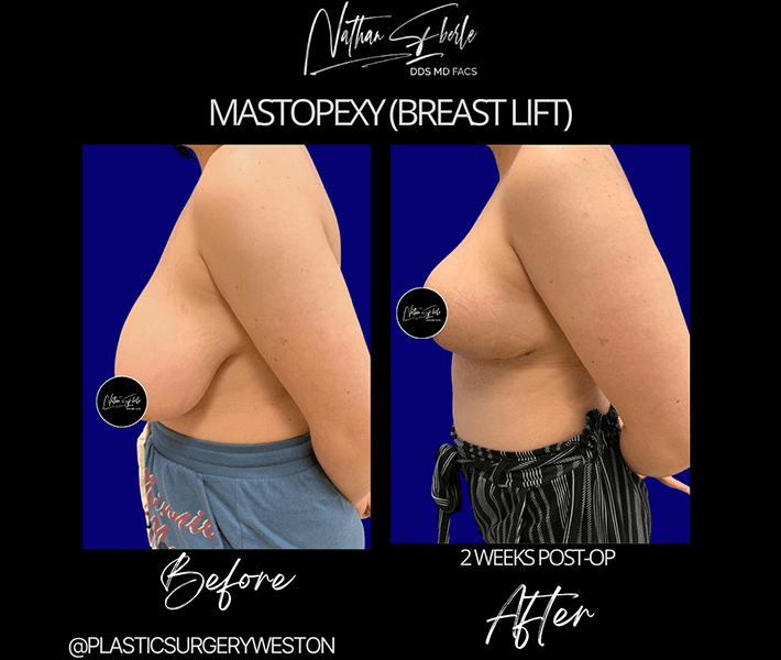 Breast Lift before and after case 5, actual patient at Weston Center for Plastic Surgery