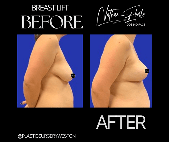 Breast Lift before and after case 6, actual patient at Weston Center for Plastic Surgery