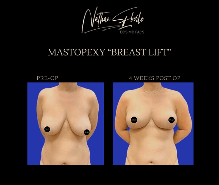 Breast Lift before and after case 7, actual patient at Weston Center for Plastic Surgery