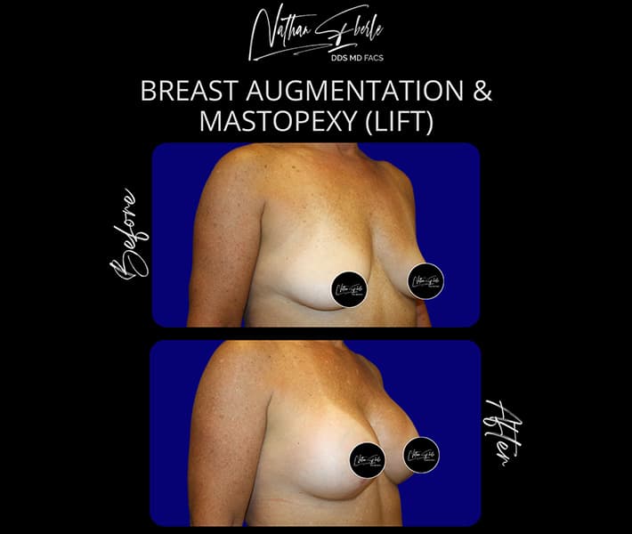 Breast Lift before and after case 9, actual patient at Weston Center for Plastic Surgery