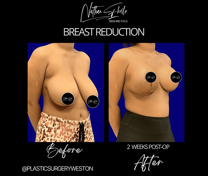 Breast Reduction before and after case 10, actual patient at Weston Center for Plastic Surgery
