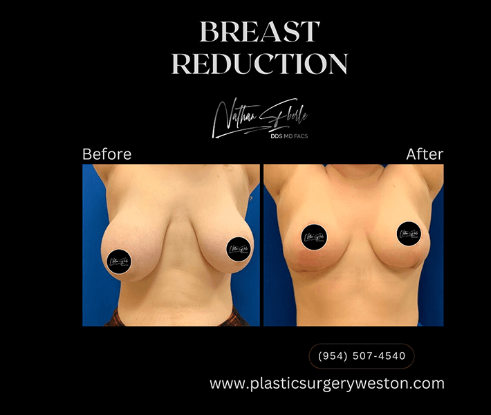 Breast Reduction before and after case 11, actual patient at Weston Center for Plastic Surgery