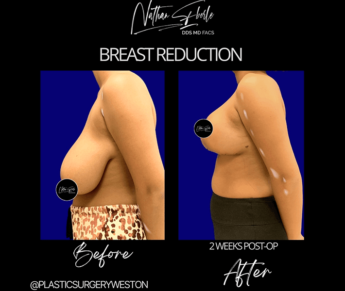 Breast Reduction before and after case 12, actual patient at Weston Center for Plastic Surgery