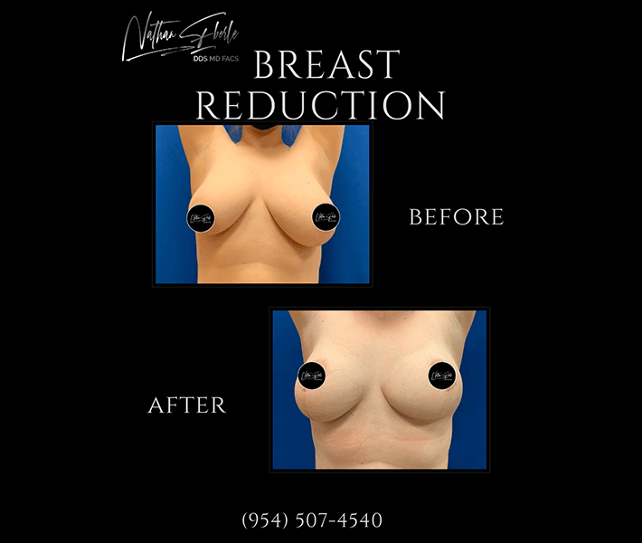 Breast Reduction before and after case 13, actual patient at Weston Center for Plastic Surgery