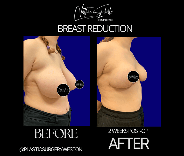 Breast Reduction before and after case 15, actual patient at Weston Center for Plastic Surgery
