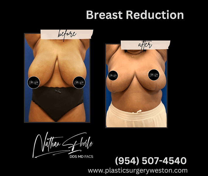 Breast Reduction before and after case 16, actual patient at Weston Center for Plastic Surgery