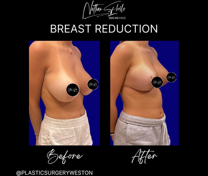 Breast Reduction before and after case 18, actual patient at Weston Center for Plastic Surgery