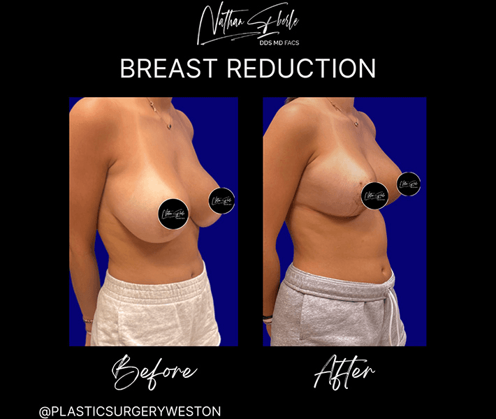 Breast Reduction case 18 before and after results at Weston Center for Plastic Surgery