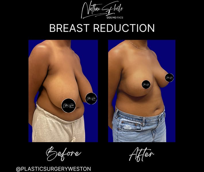Breast Reduction before and after case 19, actual patient at Weston Center for Plastic Surgery