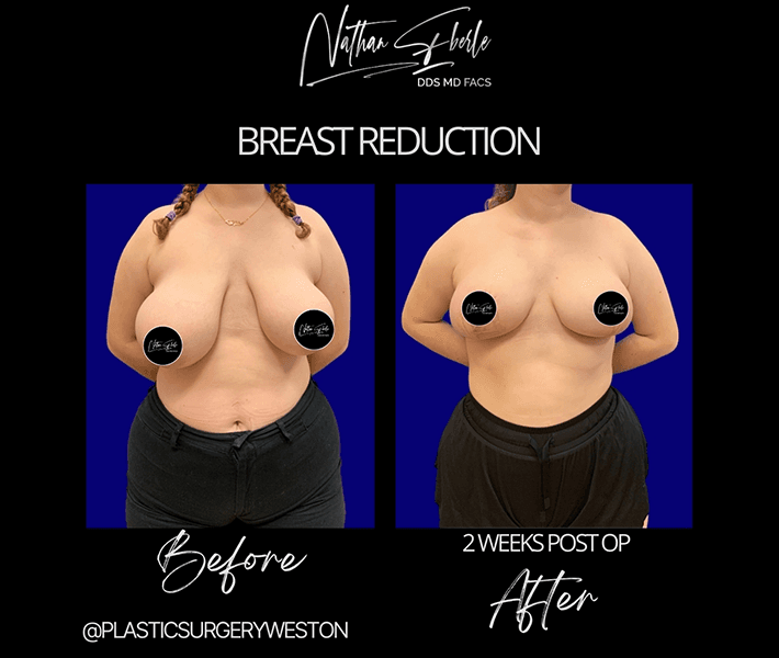 Breast Reduction before and after case 2, actual patient at Weston Center for Plastic Surgery